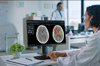 Brainomix Stroke AI Software Hailed as ῾Revolutionary,' Helping More Patients Fully Recover